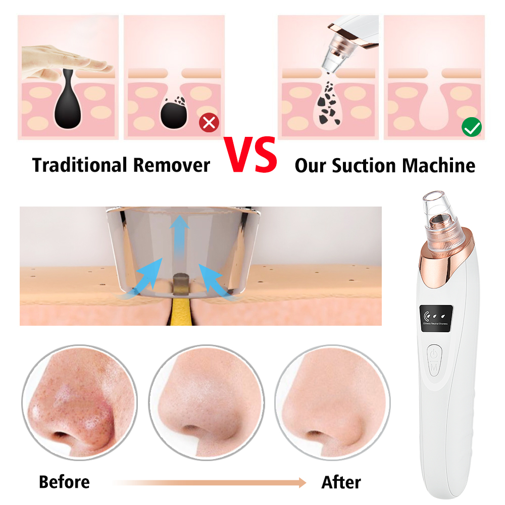 Removedor de espinillas, limpi - Pore Vacuum reseña y precio